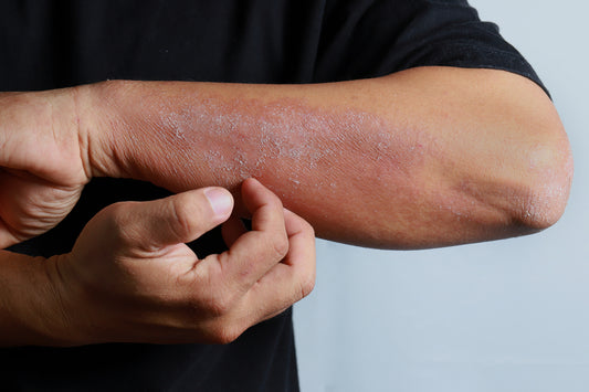 Causes of Eczema 