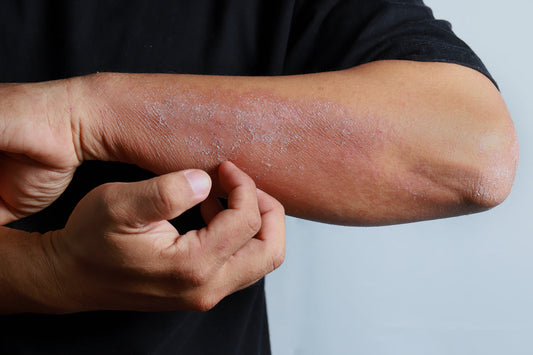 Causes of Eczema 